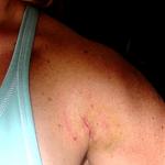 Click image for larger version

Name:	3rdmelanomaremoval5dayspostop4-05.jpg
Views:	377
Size:	19.5 KB
ID:	939948