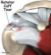 Click image for larger version

Name:	rotatorcufftear.jpg
Views:	207
Size:	3.5 KB
ID:	941250