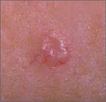 Click image for larger version

Name:	nonmelanoma.jpg
Views:	249
Size:	10.2 KB
ID:	941299