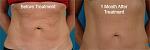 Click image for larger version

Name:	beforeafterthermageab2.jpg
Views:	330
Size:	29.4 KB
ID:	943338