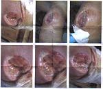 Click image for larger version

Name:	abcess.jpg
Views:	541
Size:	30.4 KB
ID:	948465