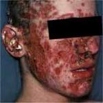 Click image for larger version

Name:	acne-b.jpg
Views:	392
Size:	4.3 KB
ID:	949000